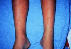 Waspadai Alergi Obat