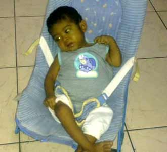 Bilqis, Bayi Pengidap Atresia Bilier