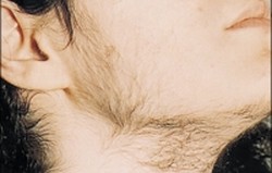 Hirsutisme