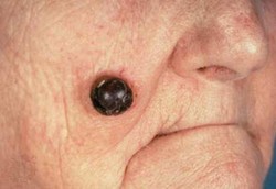 Tanda-Tanda Tahi Lalat yang Berbahaya