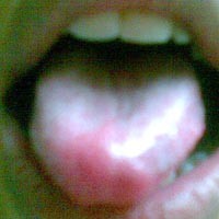 Tak Hanya Pengecap Rasa, Lidah Juga Bisa Mendeteksi Penyakit 