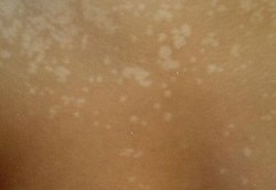 Panu yang Bikin Malu