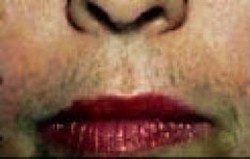 Arrhenoblastoma Ovarium