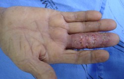 Sporotrichosis