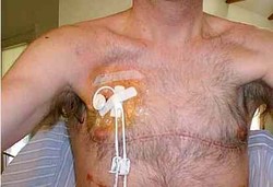 Cangkok Paru-paru Babi ke Manusia Bisa Dilakukan 2015