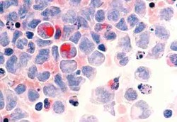 Titik Cerah Melawan Leukemia