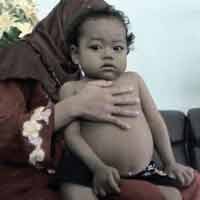 Bocah Kelainan Hati Butuh Uluran Dermawan