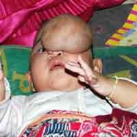 Wajah Ayu, Bayi 6 Bulan Muncul Benjolan Daging