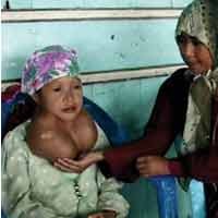 Derita Misbahanah dengan Tumor Leher Seberat 3 Kg