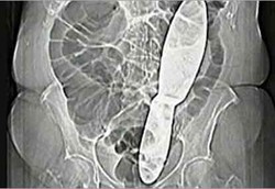 Alat Bedah Tertinggal di Perut Pasien