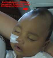 Ara, Bayi Tanpa Zat Pembeku Darah Menanti Uluran Tangan