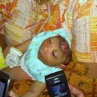 Bayi di Jember Lahir Tanpa Tempurung Kepala dan Otak Besar