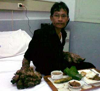 Manusia Pohon akan Kembali Dioperasi