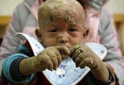 Tak Bisa Berkeringat, Kulit Balita Jadi Seperti Sisik Ikan