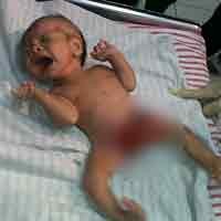 Bayi Kelainan Kelamin Jalani Pemeriksaan Sex Kromosom