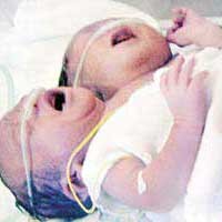 Bayi Berkepala Dua Lahir di Tuban