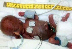 Tom Thumb Bayi Prematur Terkecil di Dunia