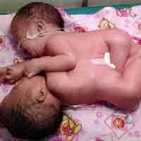 Kembar Siam Dempet Dada Kediri Memiliki 2 Jantung