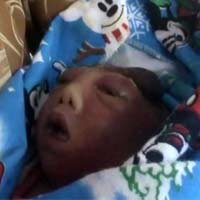Bayi di Situbondo Lahir Tanpa Tempurung Kepala 