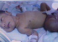 Rizki, Bayi 19 Hari Kena Tumor Langka 