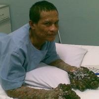 Tim Dokter Kesulitan Bedakan Jari dengan Kutil