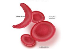 Sel Darah Merah Berbentuk Bulan Sabit yang Bikin Sengsara