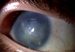 Tahi Lalat di Bola Mata, Jinak Tapi Bisa Berubah Ganas