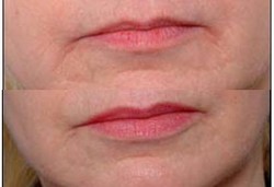 Otot Leher untuk Cangkok Bibir