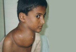 Waspadai Penyakit Hodgkins Pada Anak-anak