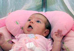 Menghilangkan Jerawat Pada Bayi