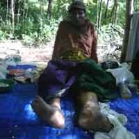 Anak Dijemput Paksa, Penderita Kusta Tak Ada yang Mengurus