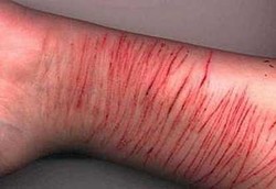 Si Hobi Melukai Diri Sendiri