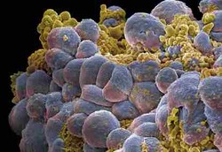 Membunuh Sel Kanker Payudara dengan Bola Es