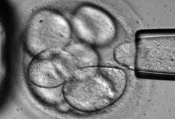Cangkok Sel Induk Langsung di Tenggorokan yang Pertama