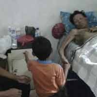 Akhirnya Penderita Kusta Bertemu dengan Anak dan Istri
