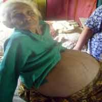 Penderita Tumor Perut Seberat 30 Kg Enggan Dioperasi