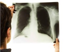 Pengendalian TB di Indonesia Mendekati Target MDG