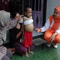 Fauzi, Bocah Kelainan Hati Asal Banyuwangi Meninggal Dunia