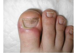 Cantengan Paling Doyan Kuku Jari yang Lembab