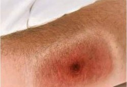 Penyakit Mematikan Antraks Muncul di Maros