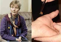 Terapi Lebah Bantu Penderita Multiple Sclerosis