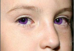 Penyebab Mata Ungu Alami 