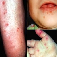 40 Anak Meninggal Akibat Penyakit Tangan, Kaki dan Mulut di China