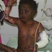 Bapak & Anak Gosong Tersambar Bensin Motor