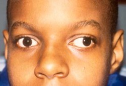 Anak Bermata Juling Berisiko Rabun Jauh