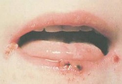 Cara Menghindari Penyakit Herpes
