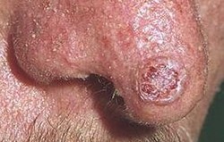 Xeroderma Pigmentosum