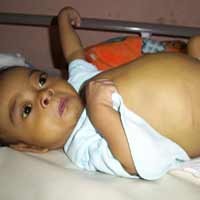 Dirawat 13 Hari, Perut Yusuf Nur Agak Mengempis