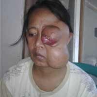 11 Tahun Terkena Tumor Ganas, Nurhayati Hanya Bisa Pasrah  