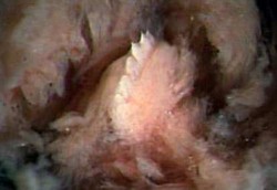 Lintah dengan Gigi Raksasa Ditemukan dalam Hidung Bocah